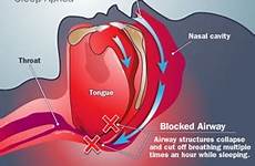 apnea sleep obstructive definition dangerous symptoms treatment causes why study airway sue dr diagram