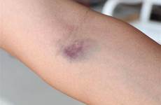 bruised humira side alcohol bruise bruising needle symptoms injecting ignore shutterstock