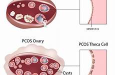 infertility female hormones excess male pcos disorder ovary polycystic syndrome symptoms ovarian nih treatment egg inside linked gene endometriosis follicle