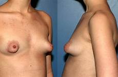 puffy malformed areolas lovely