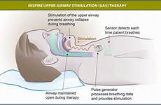 apnea shock airway obstructive sufferers electro stimulation