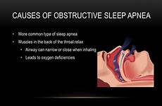 apnea sleep obstructive causes presentation breathing symptoms muscles ppt powerpoint throat