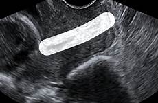 ultrasound transvaginal cervical segmentation