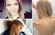 anorexia enfermedad cae muestran inspirada selfies