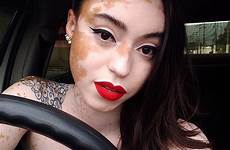 vitiligo completely brazilian turned almost skin posting redefine stephanie hopes modeling goal