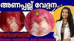 #Pericoronitis / അണപ്പല്ല് വേദന / Pericoronitis-Treatment and home remedies in Malayalam / #drshilpa