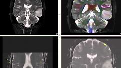 functional MRI and DTI (tractography) in practical use