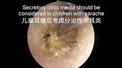 Children with earache should consider otitis media, need to do earwax cleaning first儿童耳痛要考虑中耳炎要先清理耳垢