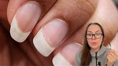 Dry and peeling nails despite of using oil.