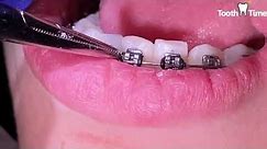 Braces Checkups - Broken bracket - Tooth Time Family Dentistry New Braunfels Texas