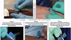 Vascular Access Cannulation Skills and Techniques