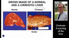 CIRRHOSIS (LIVER SCARRING) by Dr. Robert Gish