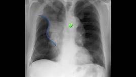Golden S-sign (lung lobe collapse) | Radiology Reference Article | Radiopaedia.org