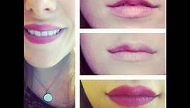 Lippen Aufspritzen und Botox - Vorher/Nachher - Meine Erfahrung