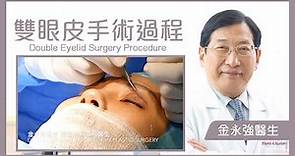 【埋線雙眼皮】手術過程 - 金永強醫生 | Double Eyelid Surgery（割雙眼皮 縫雙眼皮 單眼皮）