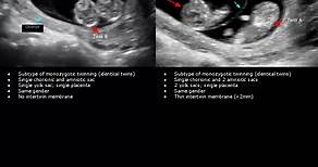 Monochorionic Monoamniotic & Monochorionic Diamniotic Twins Ultrasound Scan | Pregnancy USG #shorts