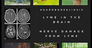 Neuroborreliosis with Lyme disease. Dr. Kyle sees these symptoms in 60% of Chronic Lyme Patients: