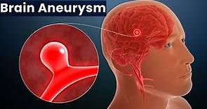 Brain Aneurysm, Causes, Signs and Symptoms, Diagnosis and Treatment.