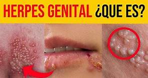 Herpes genital: síntomas, causas, transmisión y tratamientos efectivos