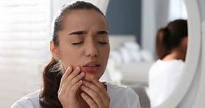 17 tratamientos naturales contra el herpes labial