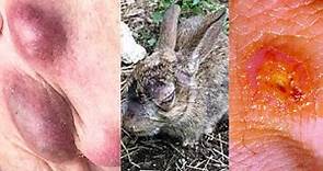 WHAT IS TULAREMIA? SYMPTOMS, CAUSES, TREATMENT