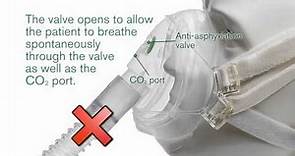 Intersurgical's FaceFit™ NIV mask with anti-asphyxiation valve