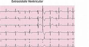 Extrasistole Ventricular EKG