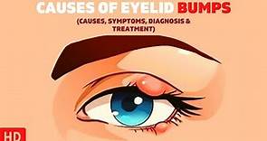 The Surprising Causes of Eyelid Bumps You Never Knew About!
