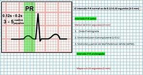 Intervalo P-R (Clases EKG #16)