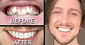INVISALIGN REVIEW - everything you need to know