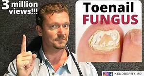 CURE Toenail Fungus (And keep it Gone FOREVER)