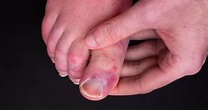 We might finally know what causes 'COVID toes'