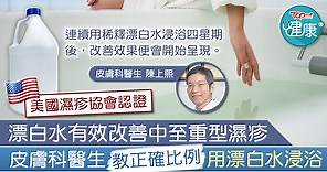 【對抗濕疹】漂白水有效改善中至重型濕疹　皮膚科醫生教正確比例用漂白水浸浴 - 香港經濟日報 - TOPick - 健康 - 健康資訊