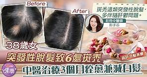 【脫髮治療】38歲女突發性脫髮致6處斑禿　中醫治療3個月痊癒兼減白髮 - 香港經濟日報 - TOPick - 健康 - 保健美顏