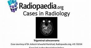 Trigeminal schwannoma (Radiopaedia.org) Cases in Radiology