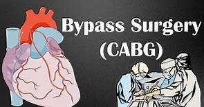 Heart Bypass Surgery (CABG) - How It Is Done