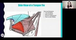 What is a Tongue Tie made of? How are Tongue Ties formed? What tongue ties look like & how to assess