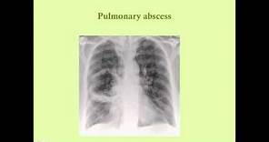 Pulmonary Infections - CRASH! Medical Review Series