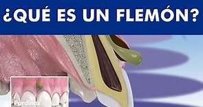 El absceso dental - Qué es un FLEMÓN y cómo se cura la infección con pus ©