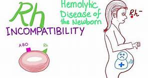 Rh incompatibility and Hemolytic disease of the newborn (HDN)