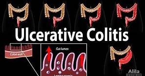 Ulcerative Colitis: Pathophysiology, Symptoms, Risk factors, Diagnosis and Treatments, Animation.