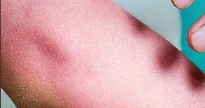 What Is Sunburn and How Is It Treated? | Apollo Hospitals