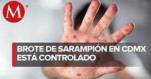 Brote de sarampión en CdMx ya está controlado, informa Secretaría de Salud
