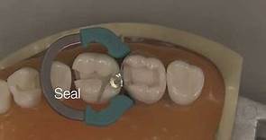 Class II Composite Restoration | Stevenson Dental Solutions