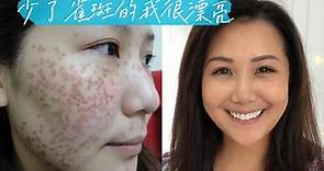 雷射除斑效果好到被盜圖，除斑30天紀錄 告別雀斑30 days Freckle removal journey in Taiwan, YAG Laser