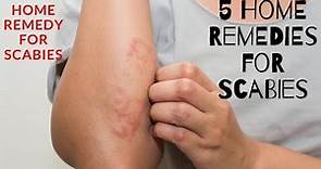 5 Home Remedies for Scabies | home remedy for scabies.