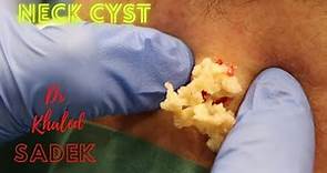 Never Ending Cyst. Dr Khaled Sadek. LipomaCyst.com