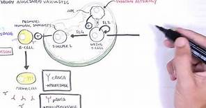 ANCA Associated Vasculitis (Anti-Neutrophil Cytoplasmic Antibody) - Causes, Pathophysiology, Types