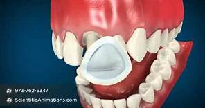 Dental Cap Procedure -- Tooth Caps