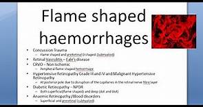 Ophthalmology Flame shaped hemorrhage Retina Causes Trauma Vasculitis CRVO Hypertensive PDR Anaemic